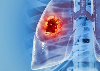 Cáncer de pulmón, letal pero el más prevenible