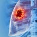 Cáncer de pulmón, letal pero el más prevenible