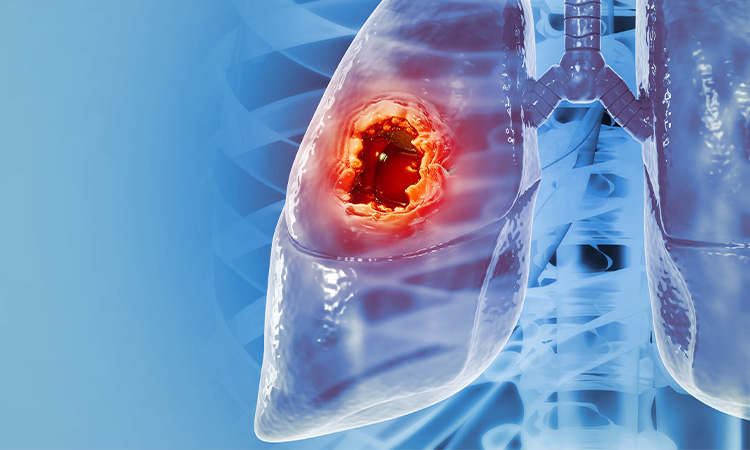 Cáncer de pulmón, letal pero el más prevenible
